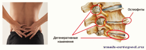 Отложение солей в поясничном отделе. Отложение солей в позвоночнике — что это и как лечить