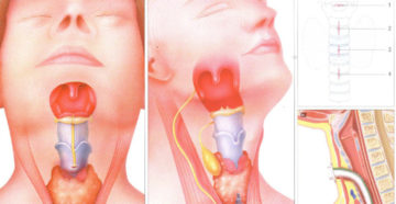 Воспаление хрящей гортани. Хондроперихондрит гортани – что это такое? Причины, симптомы, лечение Воспаление щитовидного хряща