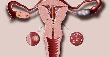 Установка ВМС: как, когда, где и на какой день ставить спираль? Сколько стоит поставить? Что бывает после установки? Все о противозачаточной спирали