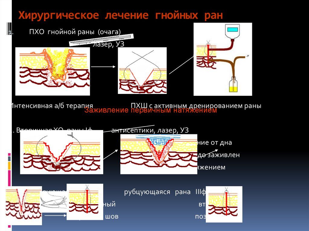 Гнойные раны — обработка и лечение в домашних условиях. Обработка и лечение гнойной раны в домашних условиях