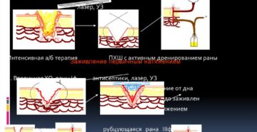 Гнойные раны — обработка и лечение в домашних условиях. Обработка и лечение гнойной раны в домашних условиях