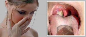 Как избавиться от неприятного запаха изо рта при тонзиллите? От чего может появиться плохой запах из горла
