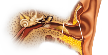 Откуда берется сера в ушах и как бороться с пробками? Почему в ушах образуется сера