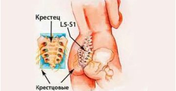 Болит крестец причины у мужчин как лечить. Боли в крестце при различных заболеваниях. Как лечить боль в крестце