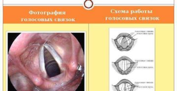 Как лечить и беречь голосовые связки. Советы врача вокалисту. Как восстановить голосовые связки в домашних условиях