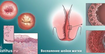 Воспаление шейки матки лечение народными средствами. Воспаление шейки матки: лечение