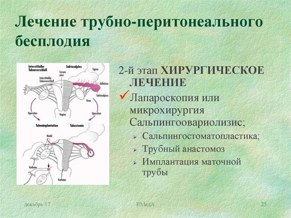 Трубно-перитонеальный фактор бесплодия. Трубный фактор и трубно-перитонеальное бесплодие. Методы лечения и ЭКО