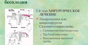 Трубно-перитонеальный фактор бесплодия. Трубный фактор и трубно-перитонеальное бесплодие. Методы лечения и ЭКО