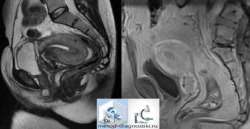 Особенности мрт малого таза у мужчин и подготовка к ней. Что показывает МРТ органов малого таза у мужчин? Показания к проведению томографии малого таза у мужчин