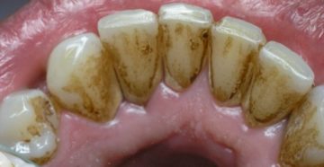 Почему чернеют зубы с внутренней стороны? Зубы чернеют у корней