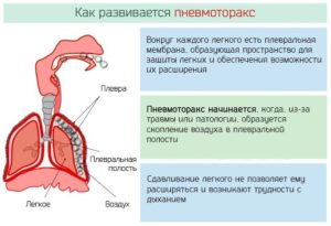 Последствия после пневмоторакса. Пневмоторакс: что это такое? Причины, симптомы и лечение пневмоторакса