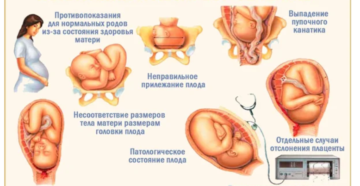 Какие показания должны быть для кесарева сечения. Можно ли попросить кесарево сечение без показаний? Делают ли кесарево сечение без показаний