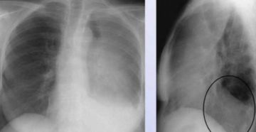 Затемнение на рентгеновском снимке. Белое пятно в легких на рентгене что это может быть