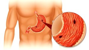 Как понять, что у тебя язва желудка? Как распознать симптомы язвы желудка
