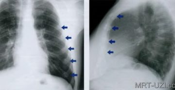 Что такое потемнение в легких. Что показывает рентген легких? Грамотная расшифровка рентгена легких
