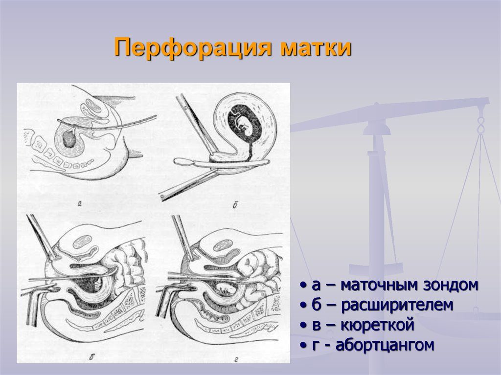 Перфорация матки после выскабливания. Перфорация матки: причины, симптомы, методы лечения, отзывы. Последствия и осложнения