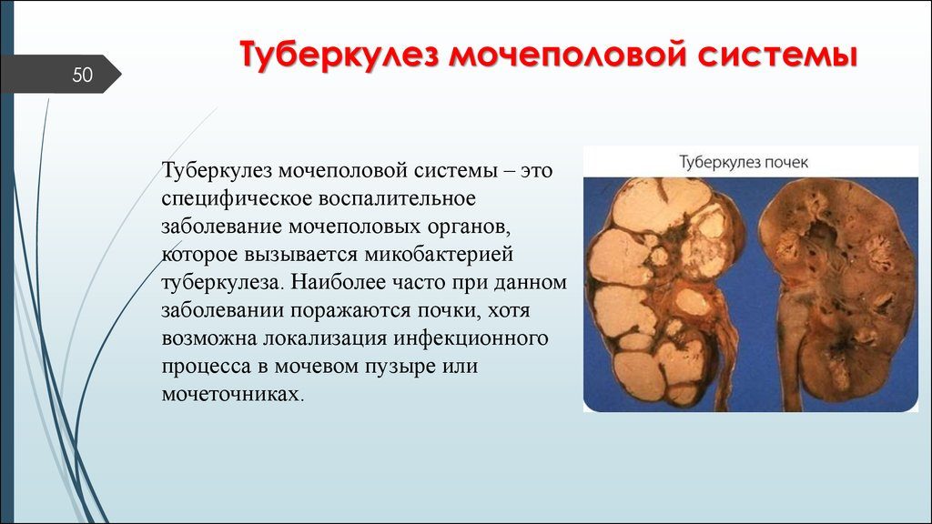 Лечение туберкулез мочевого пузыря у женщин. Туберкулез мочеполовой системы – симптомы и лечение. Причины развития болезни