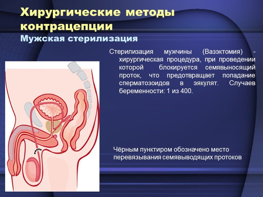 Мужская стерилизация. Преимущества и недостатки стерилизации мужчины (с ценами и отзывами)