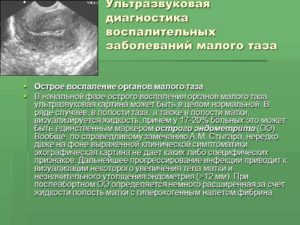 Воспаление малого таза у женщин. Воспаление органов малого таза: причины возникновения проблемы