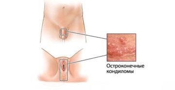 Лечение кондиломы у женщин. Кондиломы у женщин — причины, симптомы, осложнения и лечение. Можно ли предупредить появление кондилом у женщин