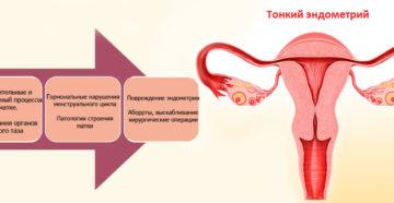 Мало эндометрия в матке. Почему появляется тонкий эндометрий