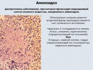 Амилоидоз - симптомы, диагностика и лечение амилоидоза. Амилоидоз подтип аа — причины, симптомы и лечение