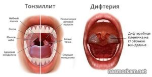 Волдыри на стенке горла без температуры. В горле волдыри: причины и лечение