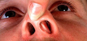 Болит слизистая носа внутри причины. Почему болит нос и как его лечить