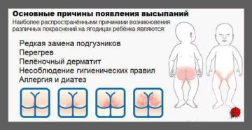 Как убрать раздражение от памперсов. Причины раздражения от памперсов, способы лечения и профилактика