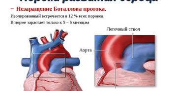 Открытый артериальный проток. Баталов проток. Незаращение Баталова протока. Врожденный порок сердца