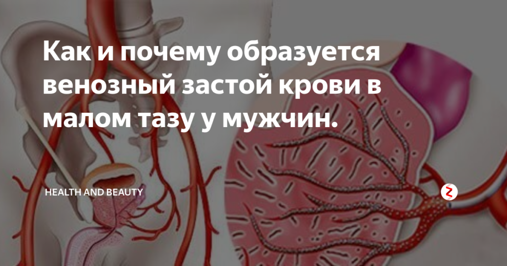 Застой в малом тазу у мужчин симптомы. Актуальные методы лечения венозного застоя крови в малом тазу у мужчин