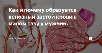 Застой в малом тазу у мужчин симптомы. Актуальные методы лечения венозного застоя крови в малом тазу у мужчин