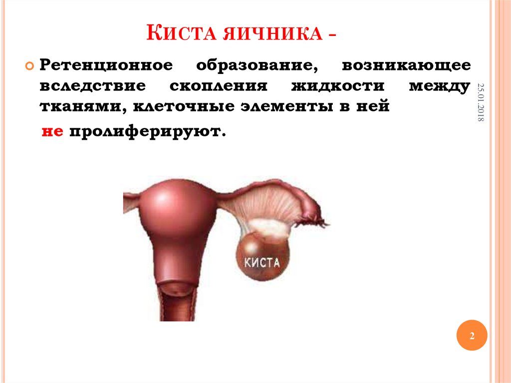 Ретенционное образование правого и левого яичника. Что такое ретенционное образование левого или правого яичника