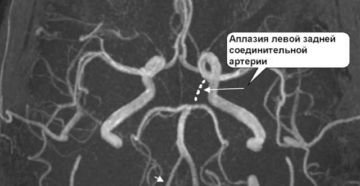 Гипоплазия артерии головного