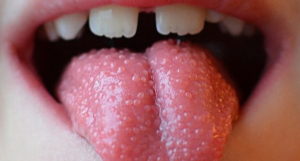 Пузырьки на корне языка: что делать, как лечить. Пузырьки на языке: причины и лечение