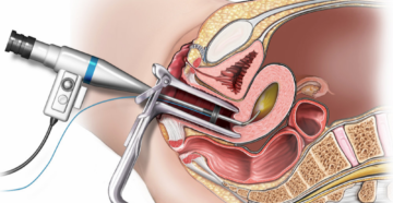 Состояние организма после гистероскопии. Осложнения и последствия гистероскопии с выскабливанием