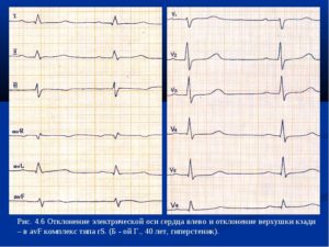 Синусовый ритм отклонение эос вправо у ребенка. Что такое электрическая ось сердца и какие могут быть последствия отклонений от нормы? Измерение показателей электрокардиографией