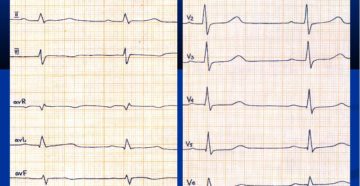 Синусовый ритм отклонение эос вправо у ребенка. Что такое электрическая ось сердца и какие могут быть последствия отклонений от нормы? Измерение показателей электрокардиографией