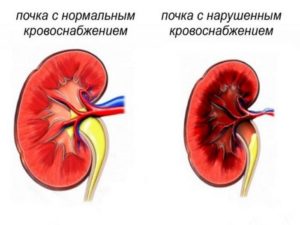 Кровообращение в почках. Нарушения кровообращения почек. Как лечить пиелонефрит