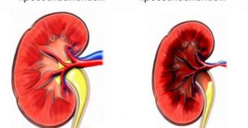 Кровообращение в почках. Нарушения кровообращения почек. Как лечить пиелонефрит