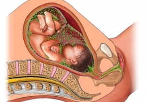 Методы лечения отита при беременности, чем опасен, влияние на плод, прогноз. Отит у беременных - особенности лечения и влияние на плод