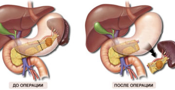 Отсутствие селезенки в организме на что влияет. Жизнь после удаления селезенки. Как избежать последствий