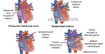 Кардиология диагноз марс что такое. Диагноз марс – что это виды симптомы и лечение. Как обнаружить особенные сердца