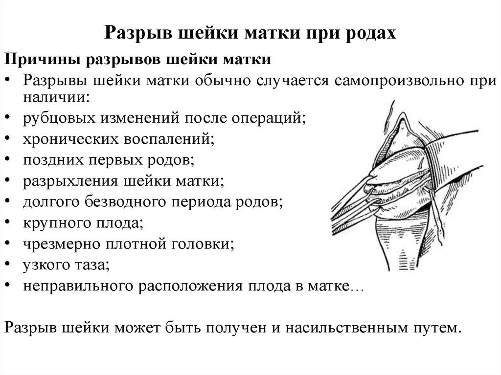 Причины и последствия разрыва шейки матки при родах, особенности лечения. Разрыв шейки матки при родах – опасное осложнение