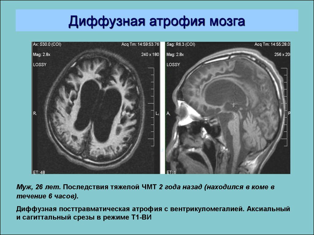 Диффузная церебральная атрофия. Как проявляется гипотрофия мозга