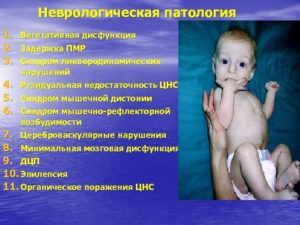 Лечение неврологии у детей. Неврологическая патология новорожденных