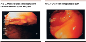 Очаговая гиперплазия слизистой желудка лечение. Что такое очаговая гиперплазия слизистой желудка