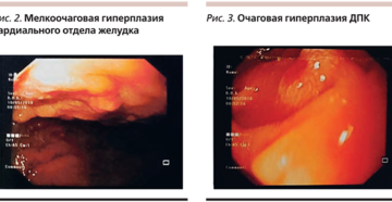 Очаговая гиперплазия слизистой желудка лечение. Что такое очаговая гиперплазия слизистой желудка