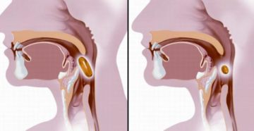 Почему трудно глотать пищу. Нарушение глотания
