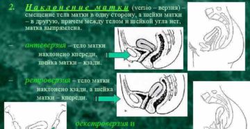 Смещение матки при беременности немного влево. Смещение матки